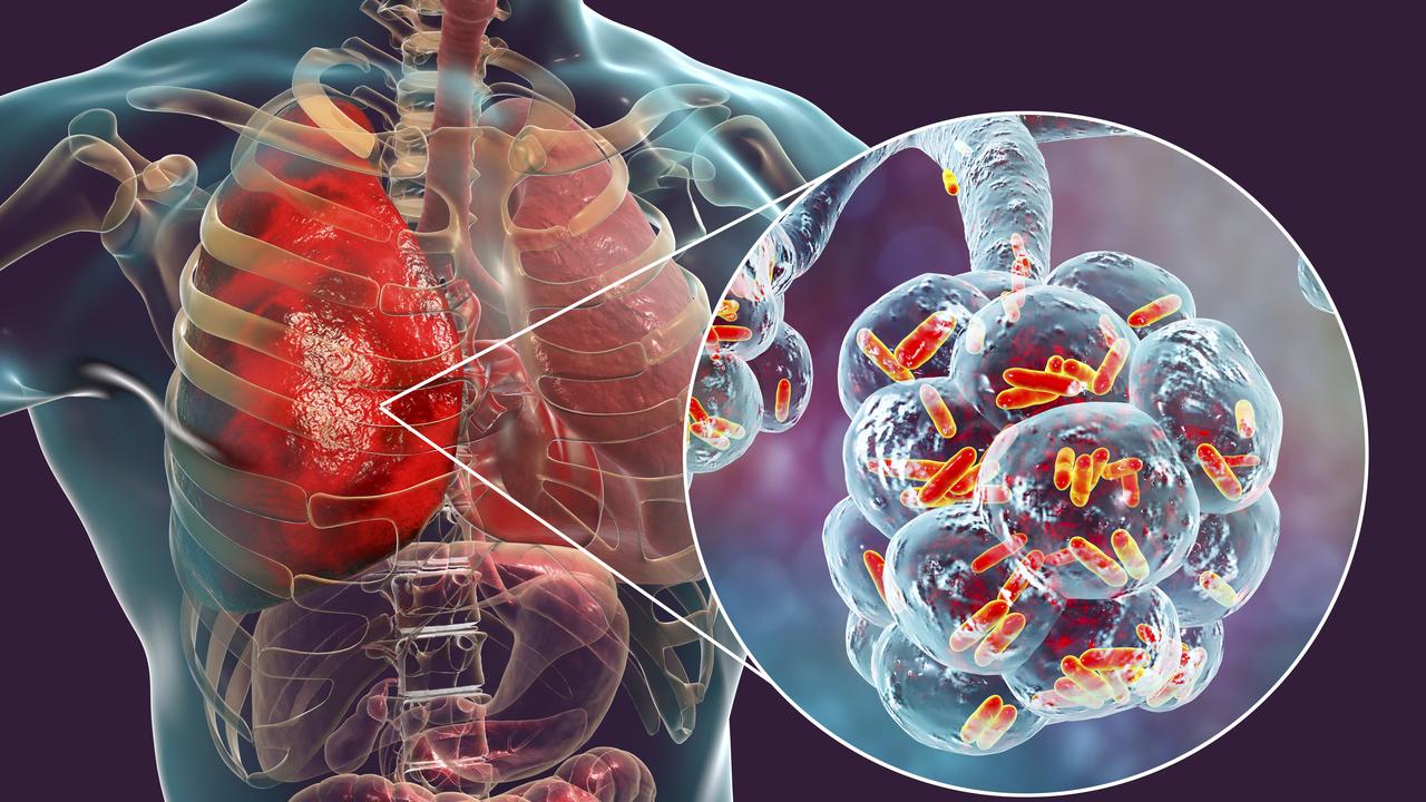 A medical concept image of bacterial pneumonia. Picture: iStock.