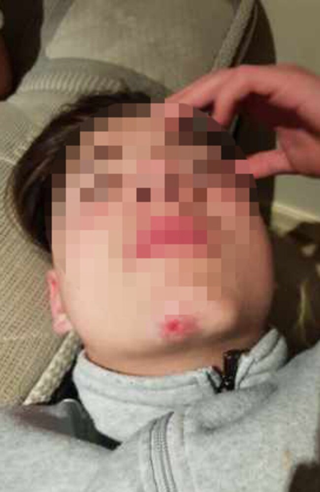 The boy was left with facial injuries. Picture: Supplied