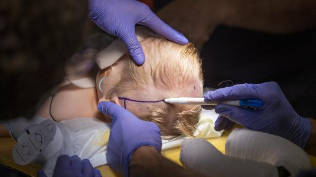 Isla had a seven-hour operation to reconstruct the rear of her skull. Picture: Alex Coppel