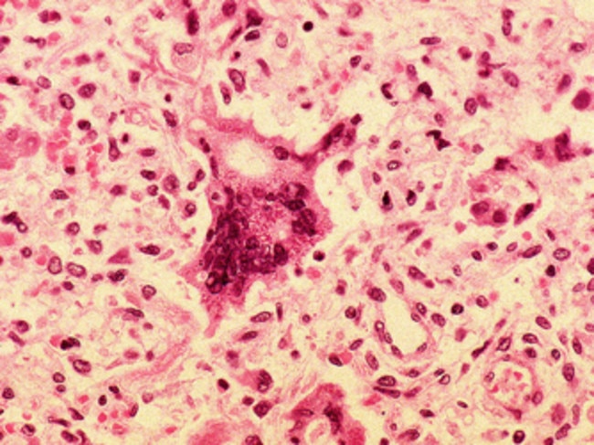 The measles virus under a microscope.