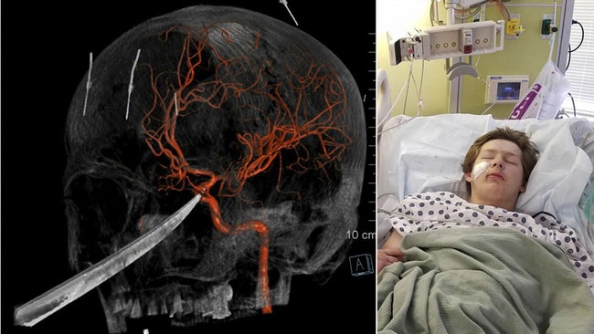 A 3-D image of the knife while implaed the skull of 15-year-old