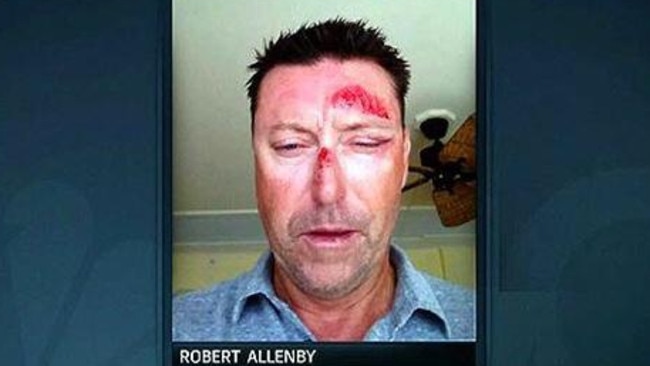 Bruised and battered ... Robert Allenby suffered cuts to his face after being robbed and beaten in Hawaii. Picture: Supplied