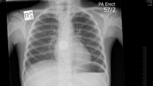 Xray shows the button battery lodged in Francesca Martin's osephagus Picture: Supplied