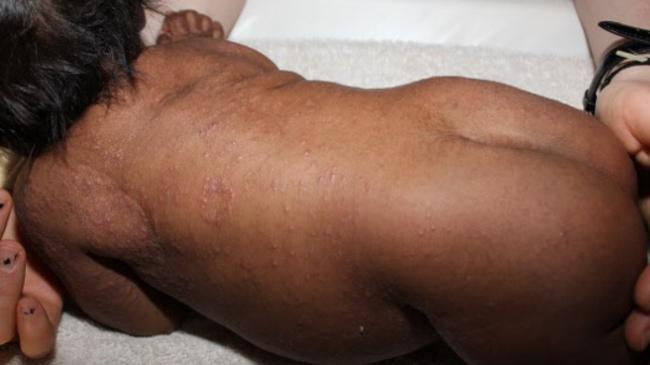 By the age of six weeks, this little girl was infested with scabies