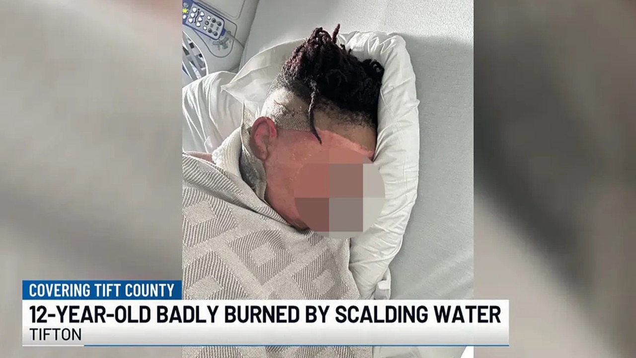 The 12-year-old boy suffered severe burns and was hospitalised. Picture: WALB NEWS 10