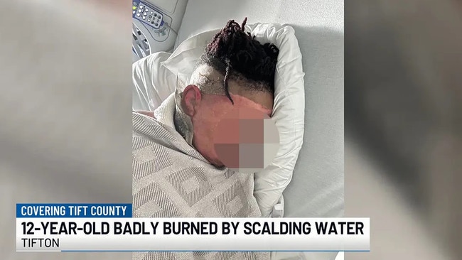 The 12-year-old boy suffered severe burns and was hospitalised. Picture: WALB NEWS 10