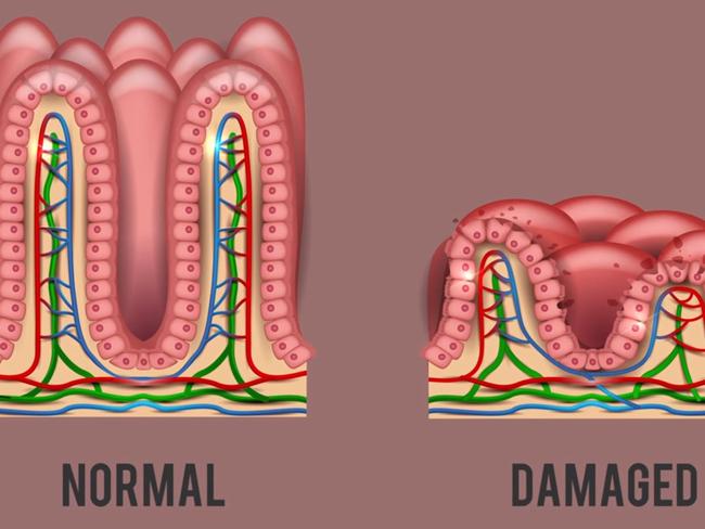 The woman likely had undiagnosed coeliac disease. Picture: Chubbyemu