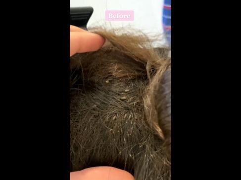 Head lice technician and spend up to 17 hours removing nits