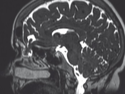 COVID-19 nasal swab test caused brain fluid to leak from woman’s nose. Picture: JAMA Otolaryngology/University of Iowa Hospitals and Clinics