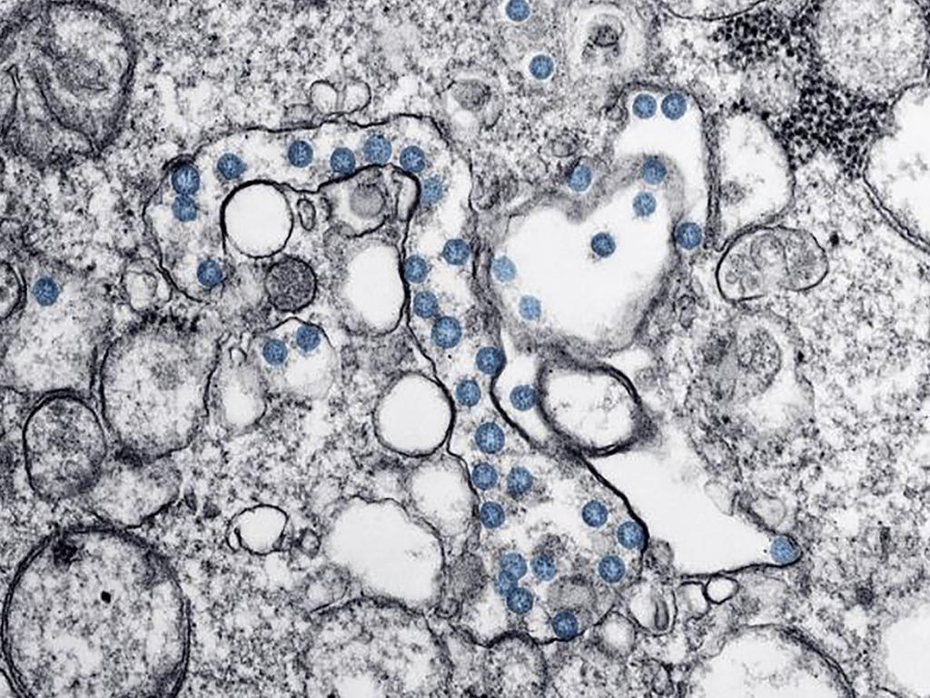 The virus genome under a microscope in a handout picture from the US Centres for Disease Control and Prevention. Picture: Centres for Disease Control and Prevention.