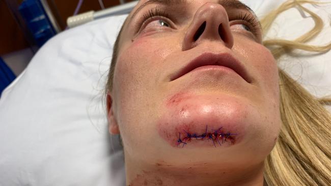 Moranbah mum Hayley Adamson, 29, was left with a fractured jaw, 12 cracked teeth and eight stitches in her chin after she says her Lime Scooter malfunctioned while she was riding it in Brisbane. Picture: Supplied