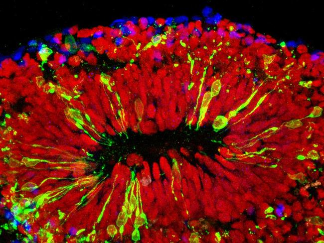 This bundle of human brain cells, known as an organoid, reveals the impact of the Zika virus. Picture: Johns Hopkins Medicine