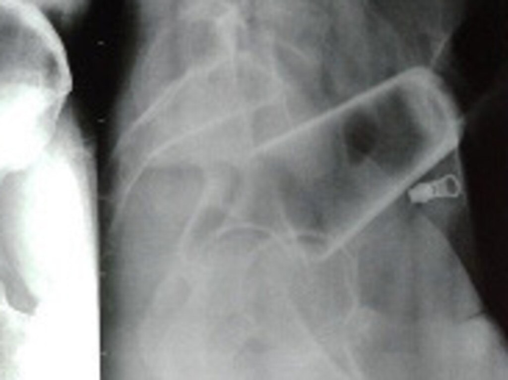 An X-ray was performed. Picture: Journal of Nepal Medical Centre.