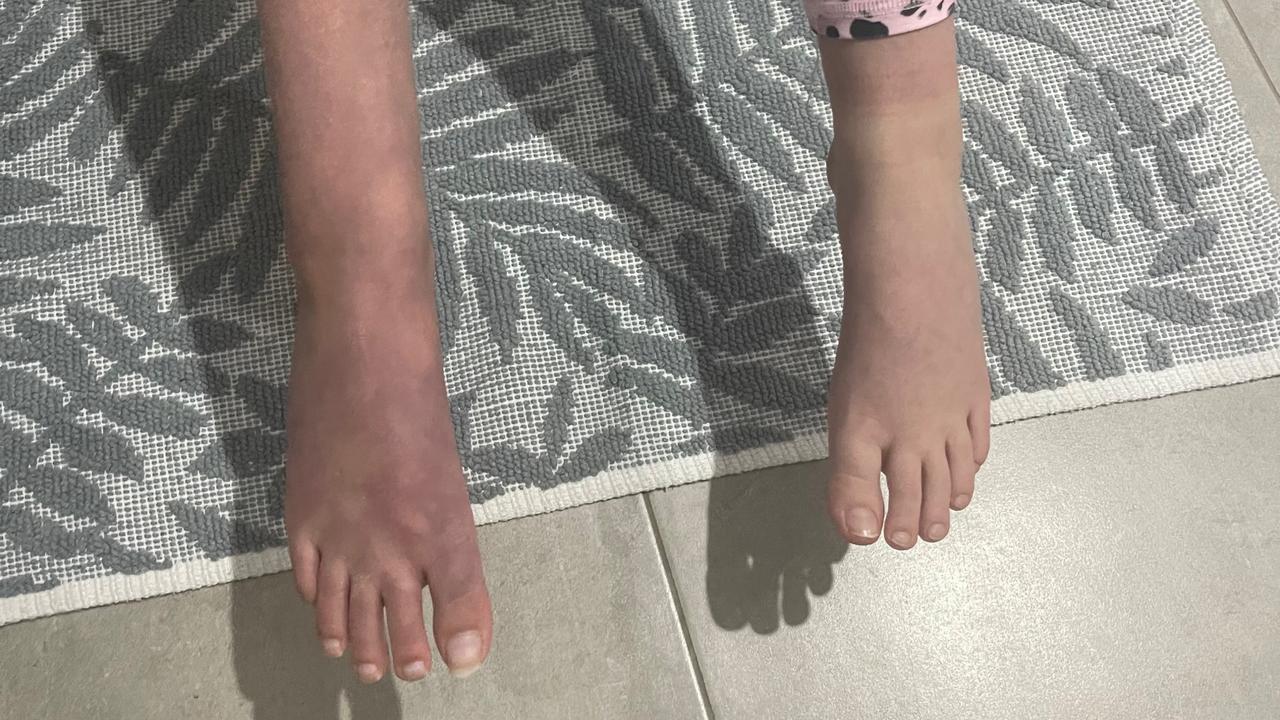 Lila Moorfoot’s injuries have caused her foot to turn purple.