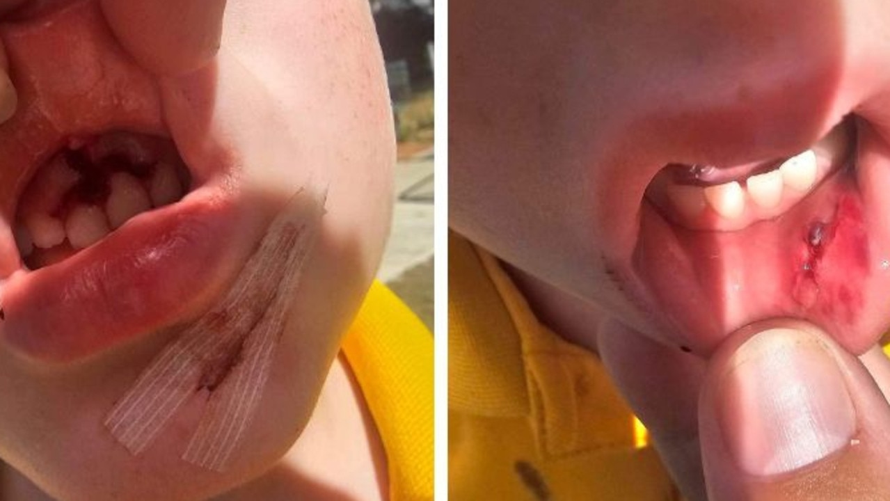 Prep student Xander had emergency dental surgery to remove the teeth stuck in his gum as a result of his playground accident on March 5, 2024.