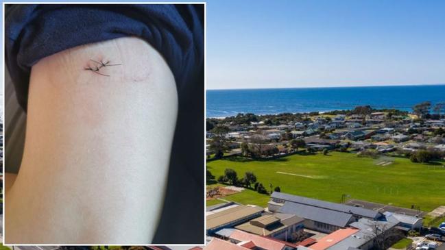 A deep 3cm-long laceration caused to a Year 6 student at West Ulverstone Primary School accidentally by a knife on August 14, 2023. Picture: Supplied