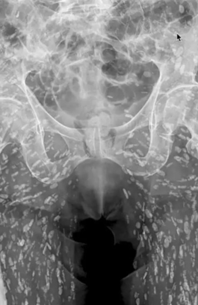 The X-ray revealed the man had hundreds of tapeworm eggs inside him. Picture: X