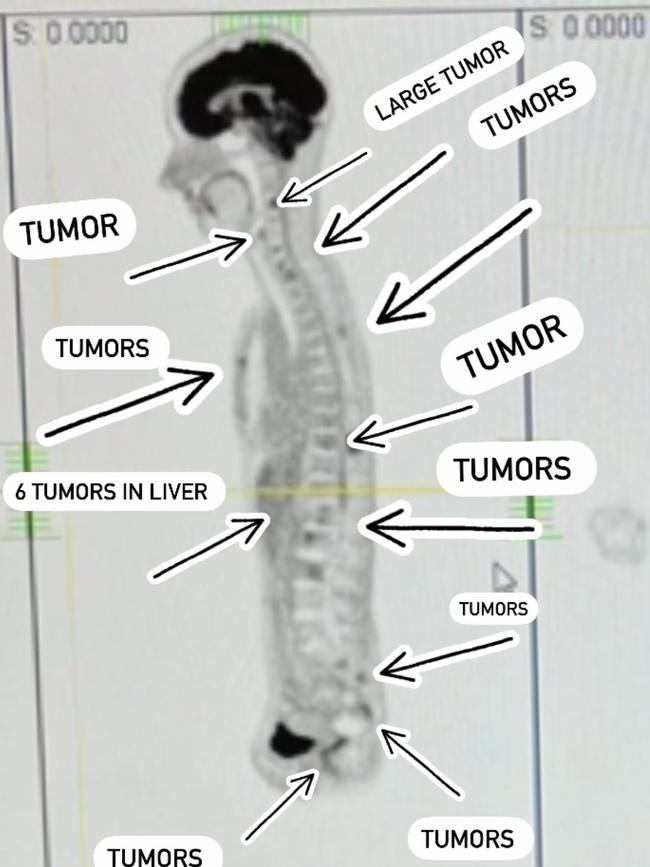 Emma Gorrick, 35, of Cromer, was diagnosed with re-occurring breast cancer in January 2020 which had spread to her bones and liver. This scan was taken in December 2020. Picture: Supplied.