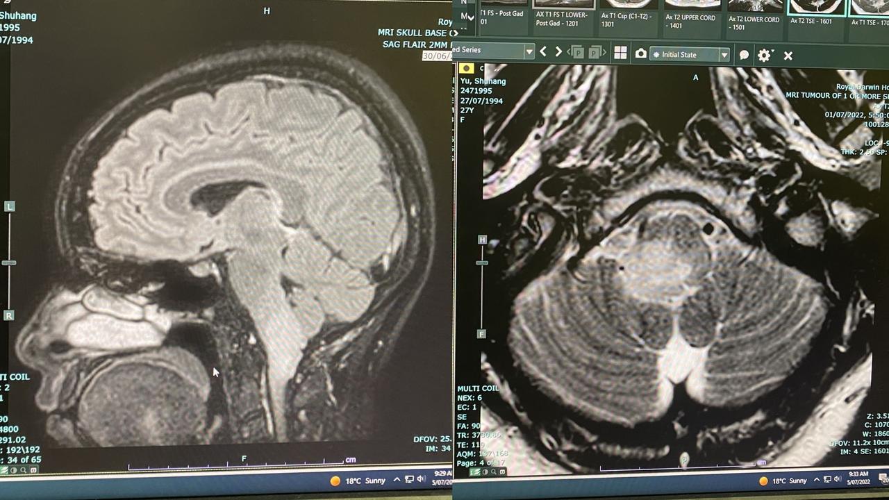 The scans of Anna’s brain cancer. Pictures: "Save Anna and her baby – new mum with brain cancer"