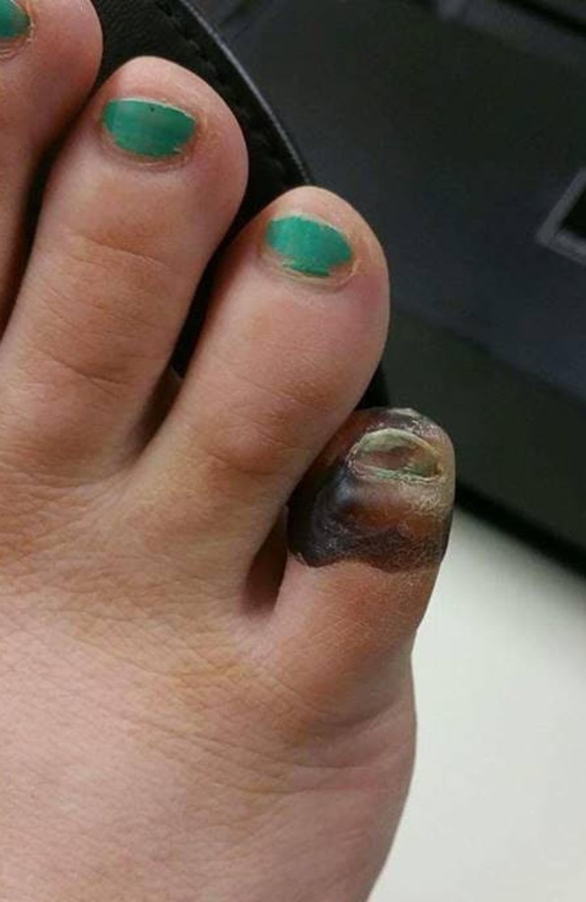 Spider bite: Woman almost loses part of foot after avoiding the doctor ...