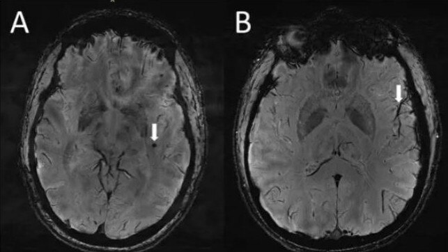 Scan A shows visible microbleeds on the brain in a patient who suffers migraines, while scan B shows the drainage system on a person who doesn’t suffer. Picture: Radiological Society of North America