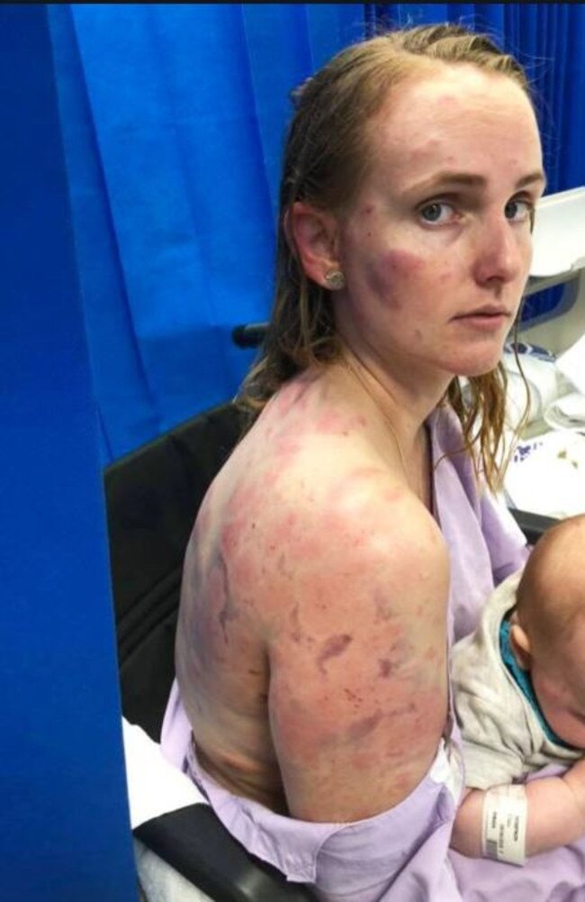 Fiona Simpson was left battered and bruised after she shielded her baby from hail when the windows of her car blew out during the fierce storm. Picture: Supplied