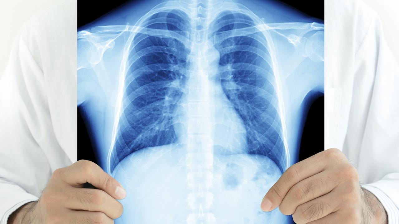 Lung cancer: Boost for Victorian researchers’ bid to extend patients