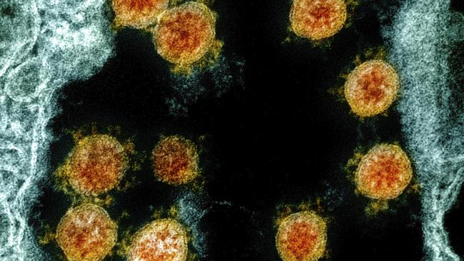 An electron microscope image of Novel Coronavirus SARS-CoV-2 virus particles. Picture: AP