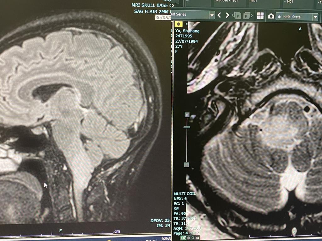 The scans of Ms Yu’s tumour. Picture: Supplied