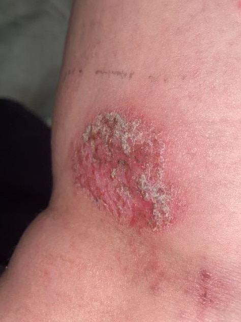 Leilah also suffers from discoid eczema, where scabs develop and weep. Picture: Supplied