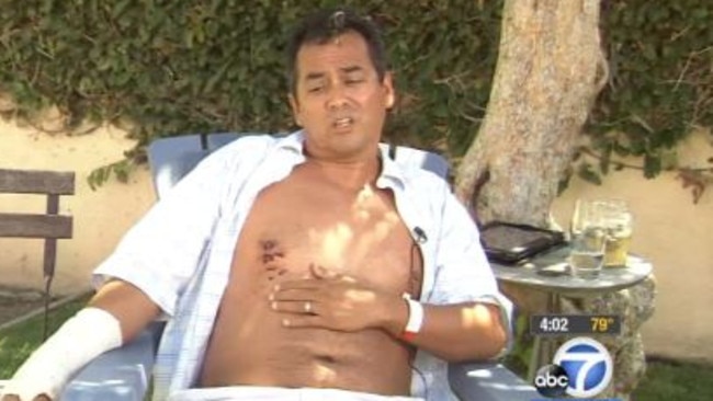 His injuries ... Steven Robles survived a shark attack in California. Picture: ABC News US