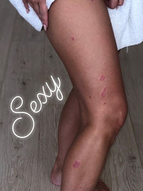 Kim Kardashian West shares brutally honest account of living with psoriasis. Picture: Instagram