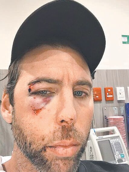 Grant Hackett posts a photo of himself on Instagram with a black eye. Photo: Instagram