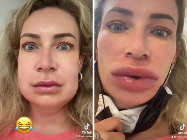 A woman has revealed the disastrous outcome of her decision to get lip filler. Picture: TikTok