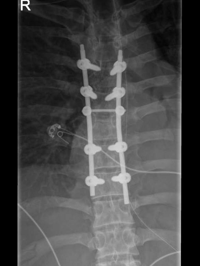 Christian had steel rods and screws in his spine.