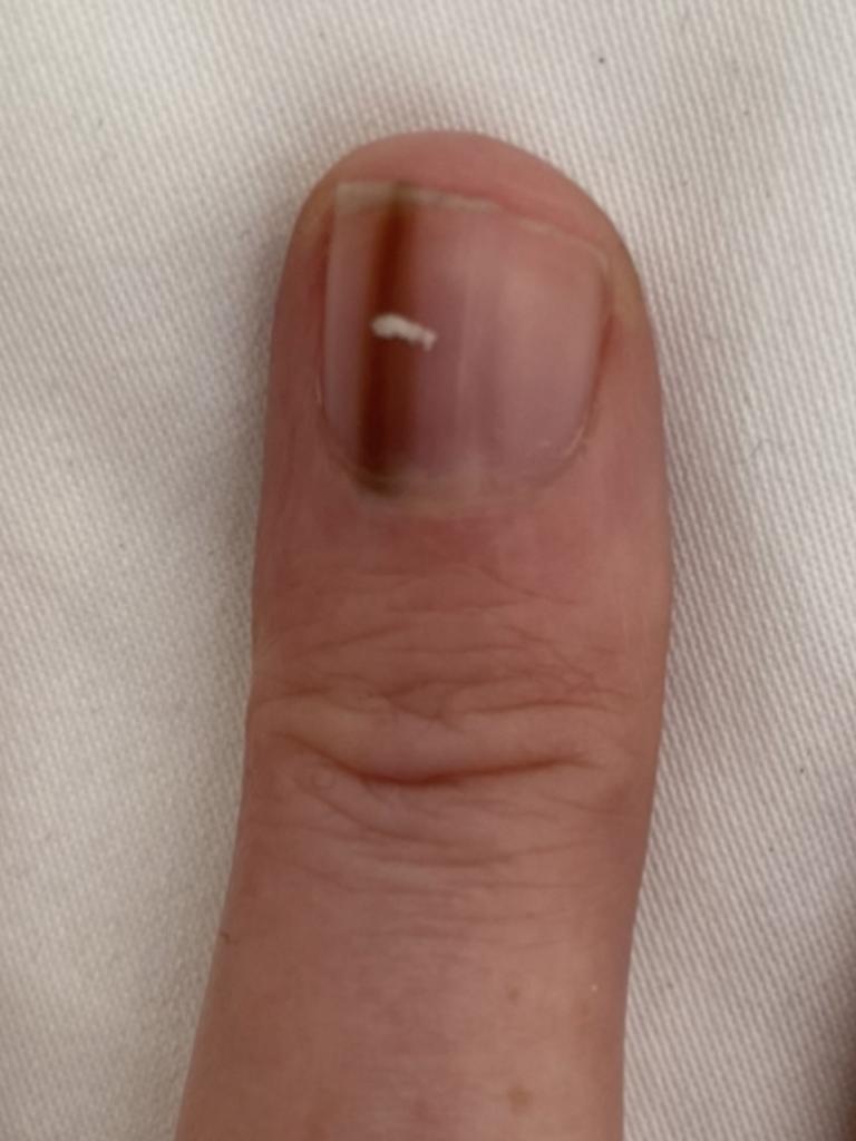 Doctors had to take a biopsy but when her nail grew back, the mark grew back even darker. Picture: Kennedy News and Media