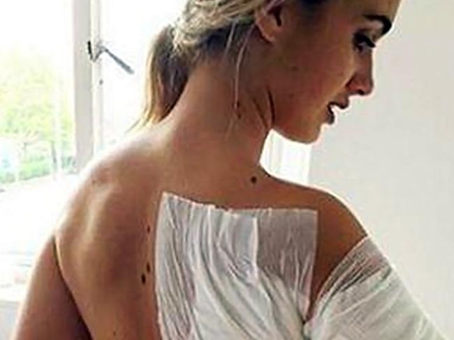 Australian model Isobella Fraser and her sister were both victims of an acid attack in a London nightclub on April 18, 2017.