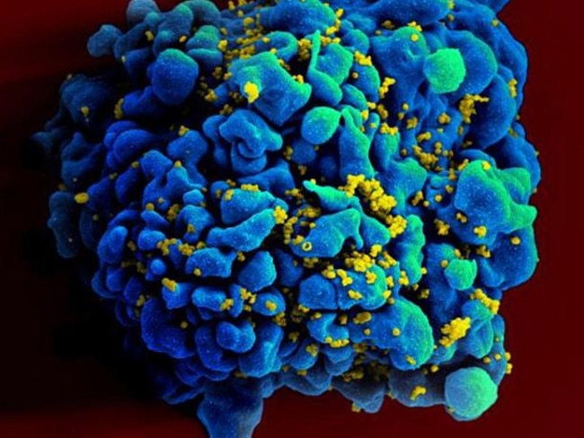 This April 12, 2011 electron microscope image made available by the National Institute of Allergy and Infectious Diseases shows an H9 T cell, blue, infected with the human immunodeficiency virus (HIV), yellow.