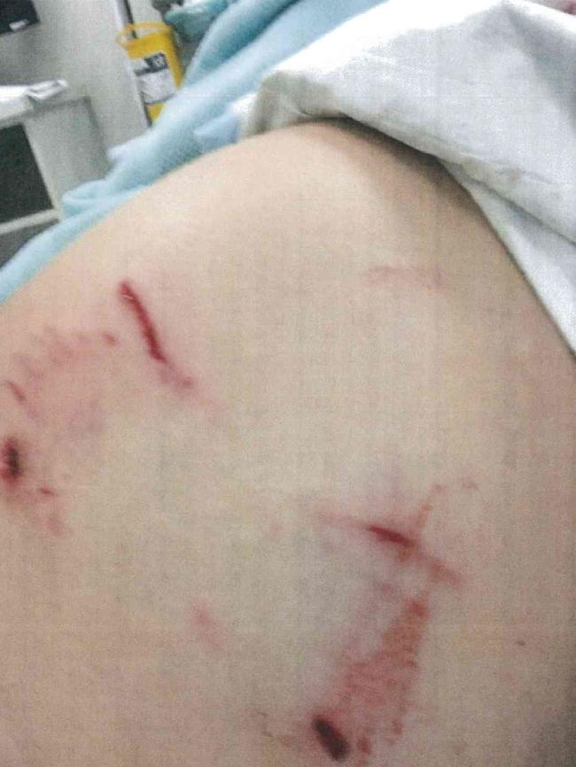 Photos showing a woman's injuries allegedly sustained by a bite from Sarge the staffy. Source: Moreton Bay Regional Council