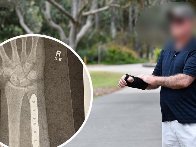 Defence force Vet’s arm snapped by teen in brutal alleged attack