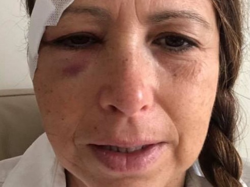 Nicole Feledy has publicly thanked all those people who helped her after she suffered a number of facial fractures when she was hit by a car while crossing at traffic lights at the intersection of Forest Way and Morgan Rd at Belrose. Picture: Facebook