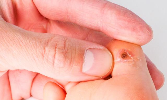 Pediatrician checking a big toe of child with an infected callus wart