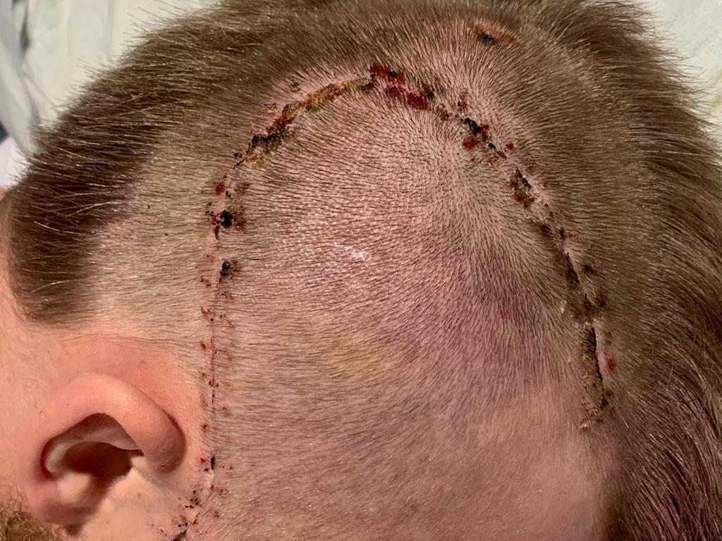 Harry Froling bears the scars of surgery to repair his fractured skull and alleviate bleeding on the brain. Picture: Shane Froling/Twitter