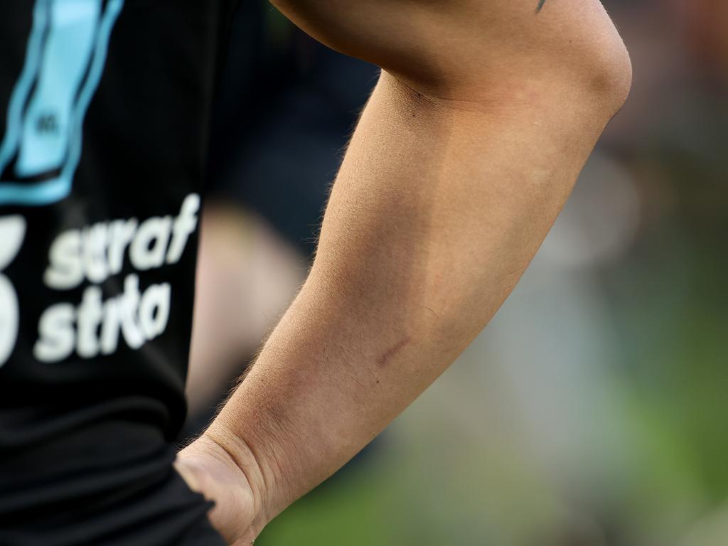 Shaun Johnson’s arm after the incident.