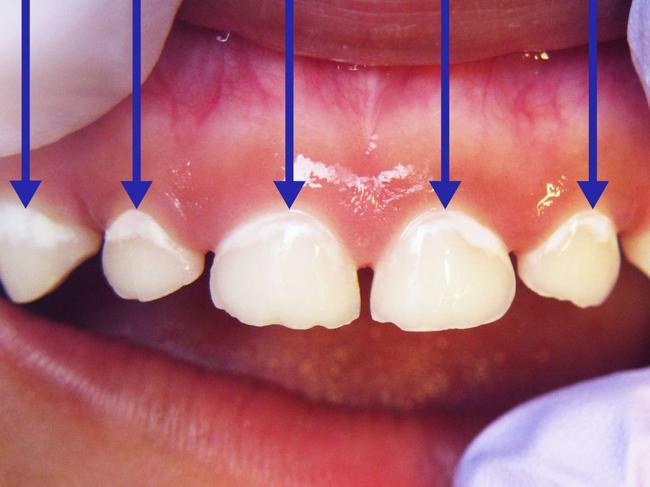 White lines on the top teeth near the gum line can be an early sign of decay in children's teeth. Picture: SA Dental.