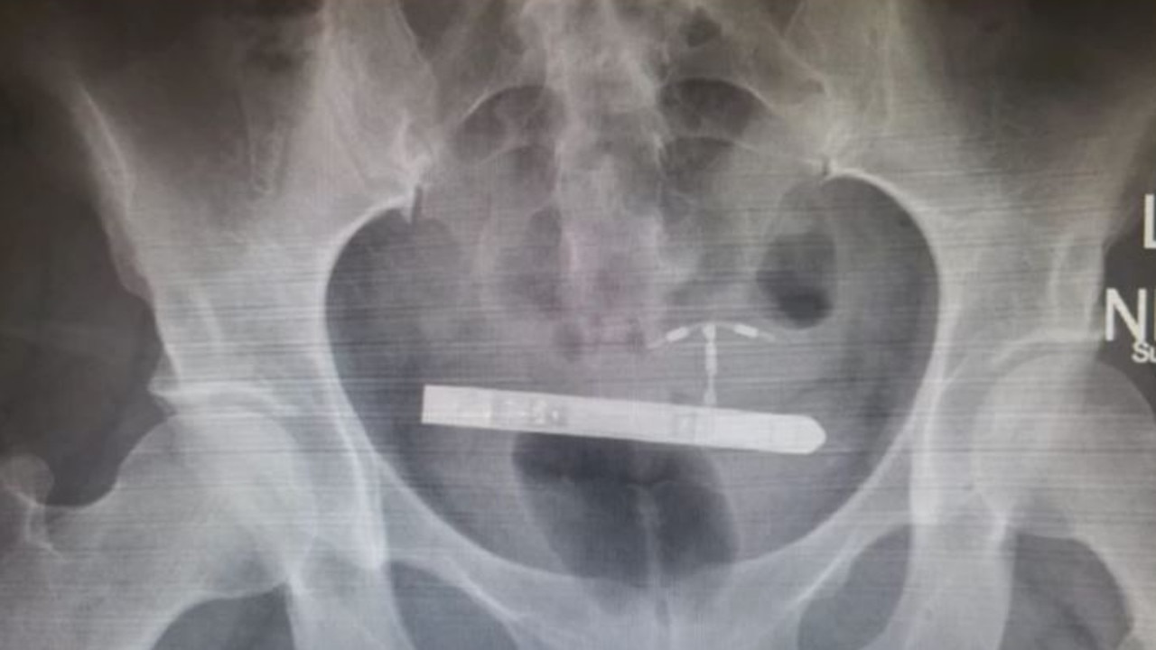 Woman Forced To Get Surgery After Vibrator Gets Stuck In Her Bladder Au — Australias 