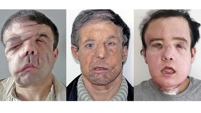 In a medical first, a French surgeon says he has performed a second face transplant on the same patient.