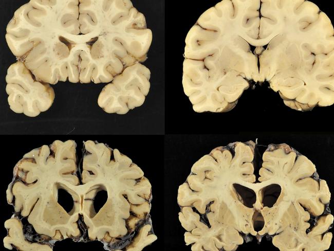 This combination of photos provided by Boston University shows sections from a normal brain, top, and from the brain of former University of Texas football player Greg Ploetz, bottom, in stage IV of chronic traumatic encephalopathy.