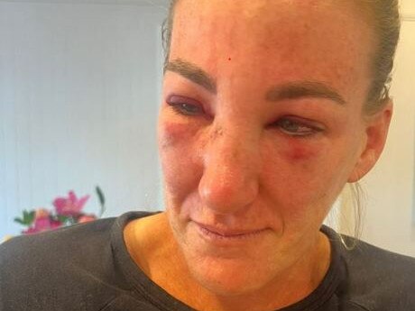 Ali Brigginshaw is suffering from swelling and bruising after sustaining a broken nose during Sunday's game against the Canberra Raiders. Photo: Instagram @katessunshine_