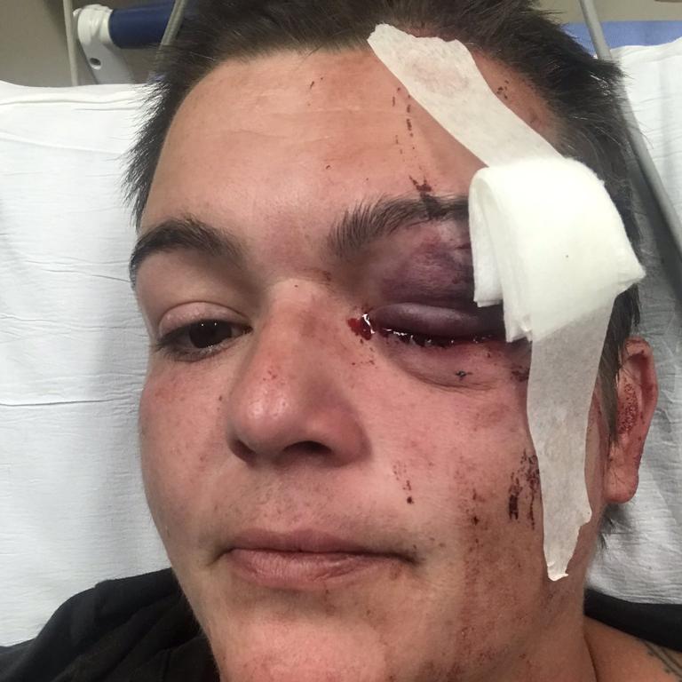 Linda Tirado says she is now blind in her left eye after being shot by police at protests in Minneapolis. Picture: Linda Tirado via Twitter